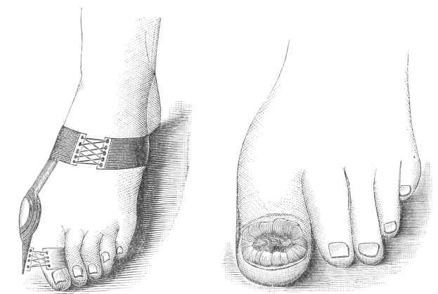 Schwarze und weiße Zeichnung von zwei Füßen, einer mit Verband und der andere mit Bruch, mit Text, der den Verband als Behandlung anzeigt.